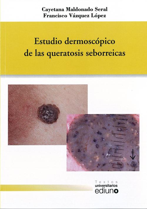 Estudio dermoscópico de las queratosis seborreicas