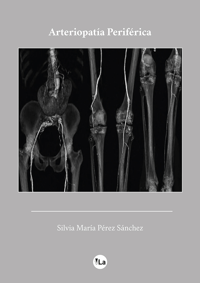 Arteriopatía Periférica