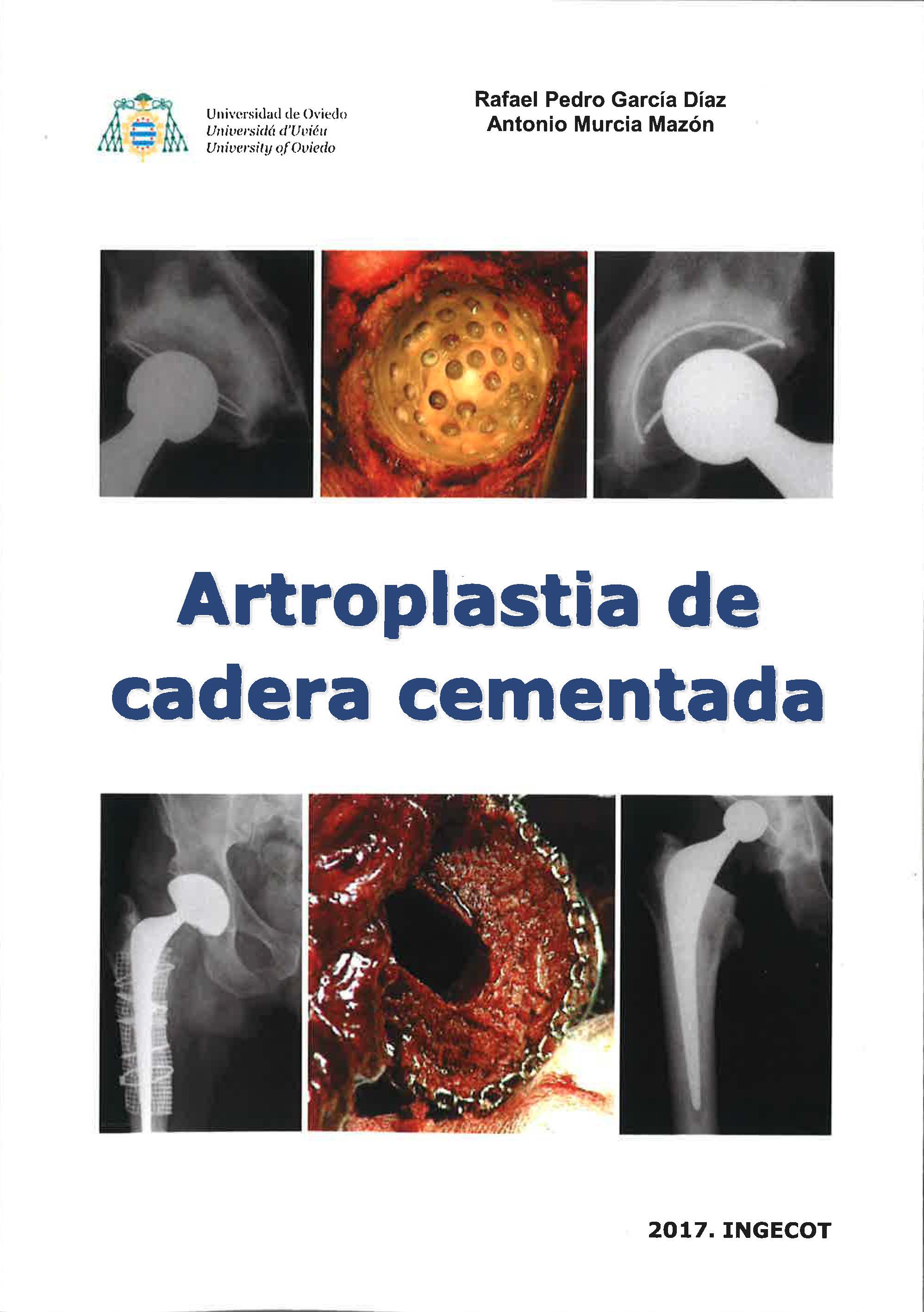 Artroplastia de cadera cementada