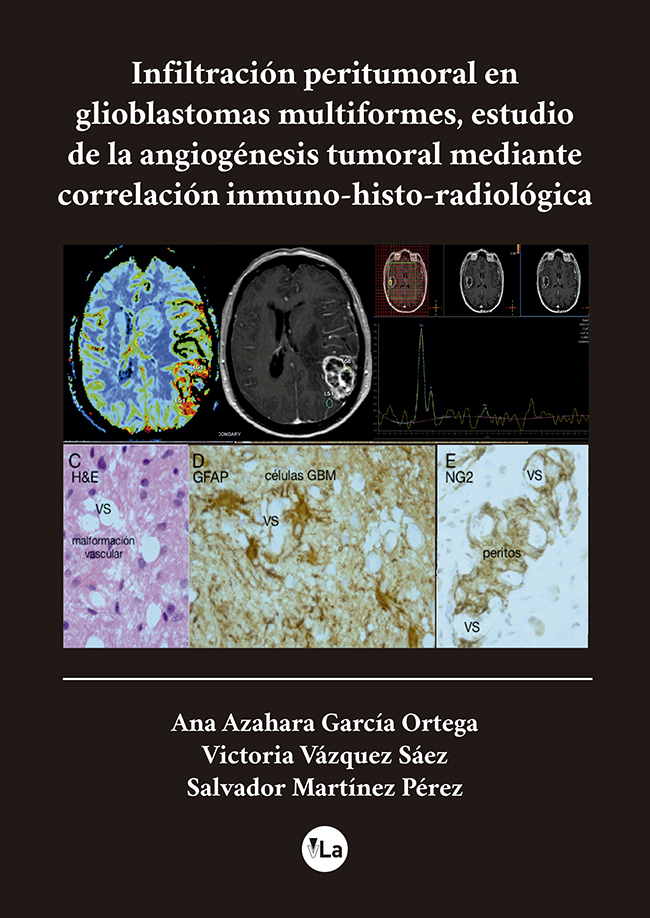 Infiltracion peritumoral en glioblastomas multiformes, estudio de la angiogénesis tumoral mediante correlación inmuno-histo-radiologica