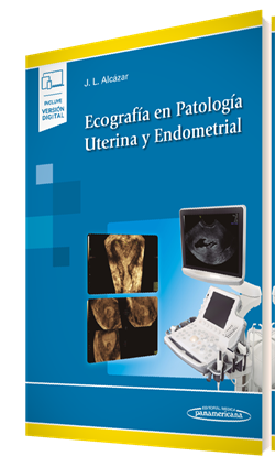 Ecografía en Patología Uterina y Endometrial