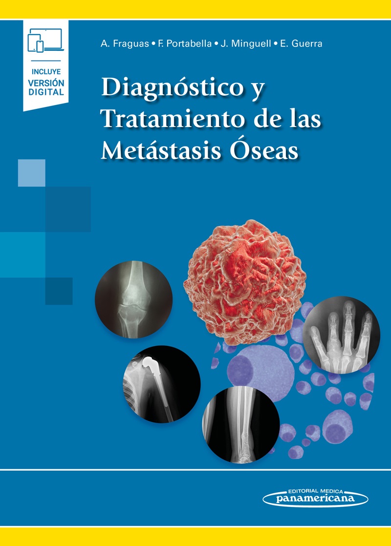 Diagnóstico y Tratamiento de las Metástasis Óseas